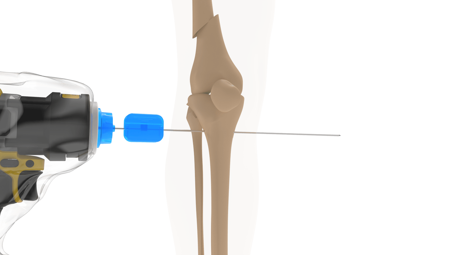 Distal Traction Rotation How to Perform: Distal Femoral Traction - Arbutus Medical