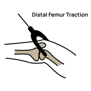 Distal Femur Traction